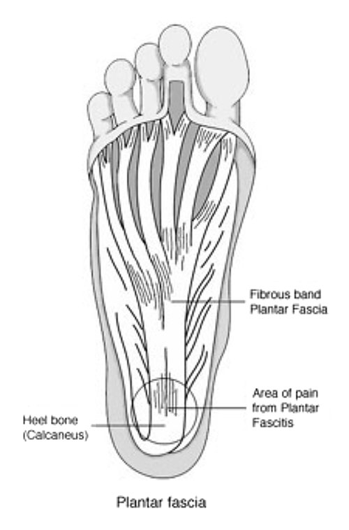 Plantar fasciitis treatment