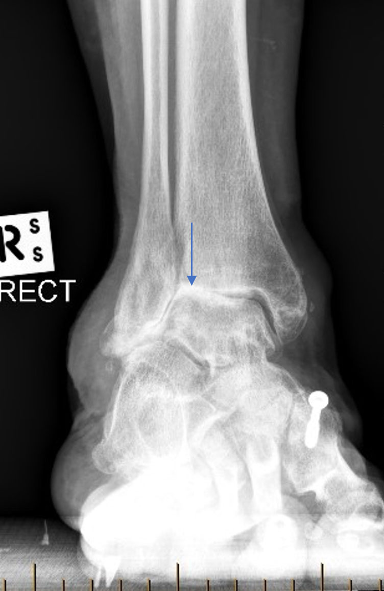 Ankle osteoarthritis may require ankle fusion surgery