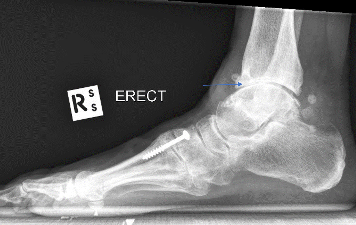 Ankle osteoarthritis may require ankle fusion surgery