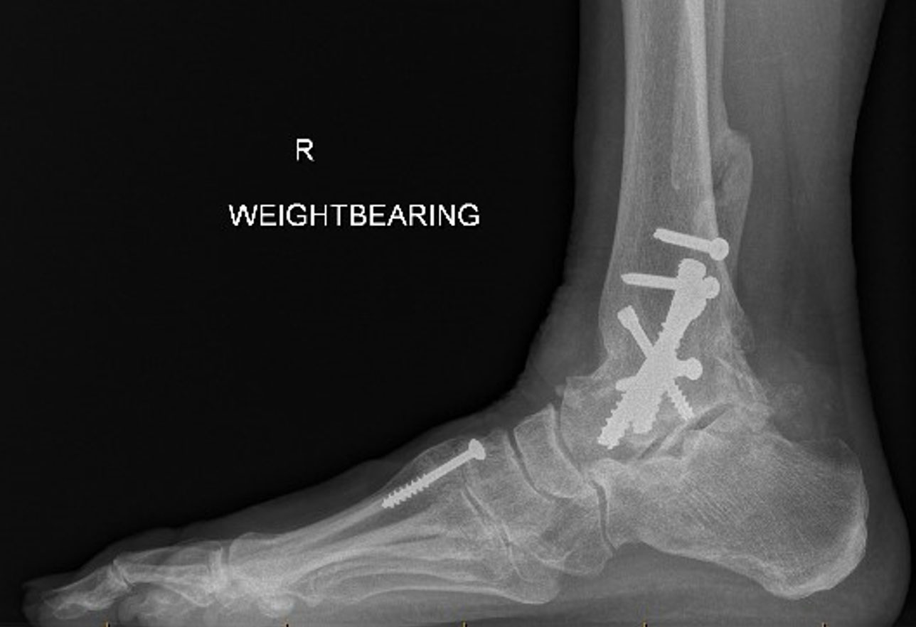 Xrays showing appearance after ankle fusion surgery