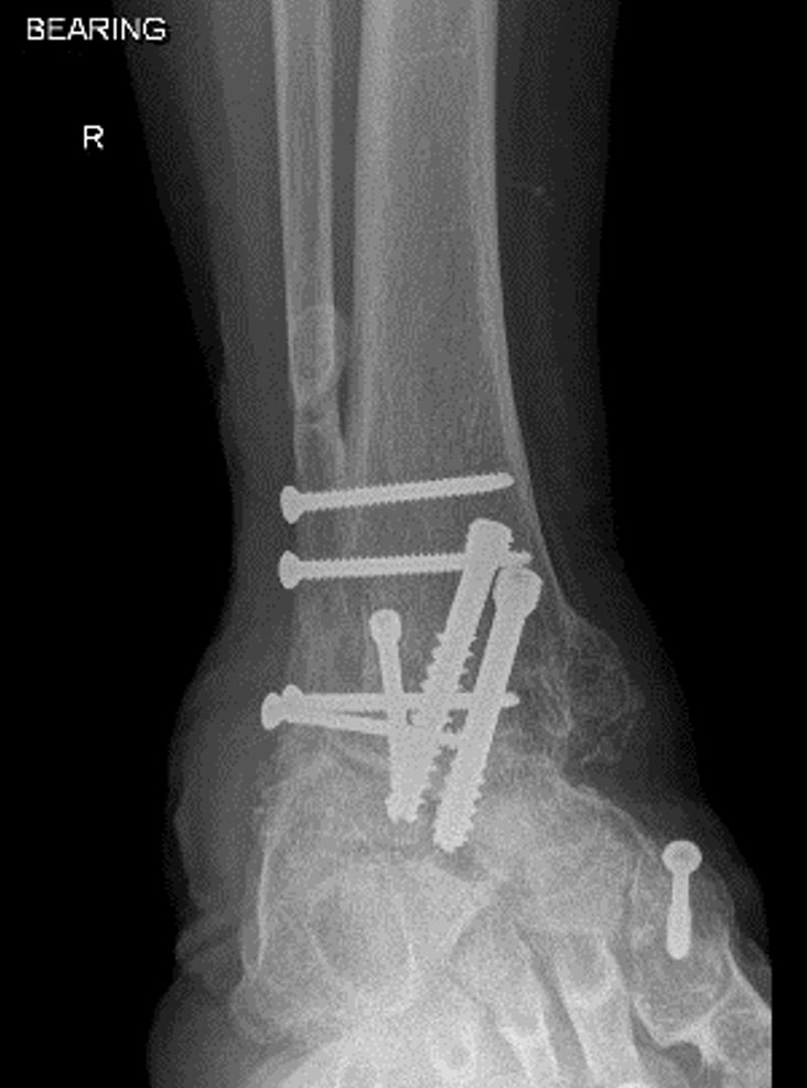 Xrays showing appearance after ankle fusion surgery