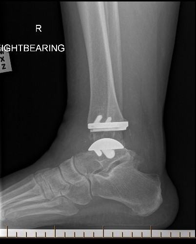 Total Ankle Replacement - Norwest and North Shore
