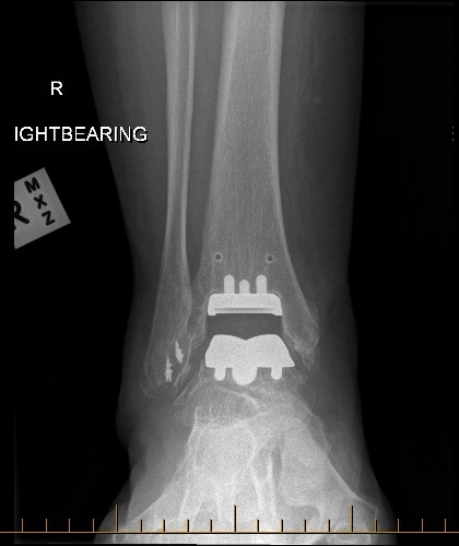 Total Ankle Replacement - Norwest and North Shore