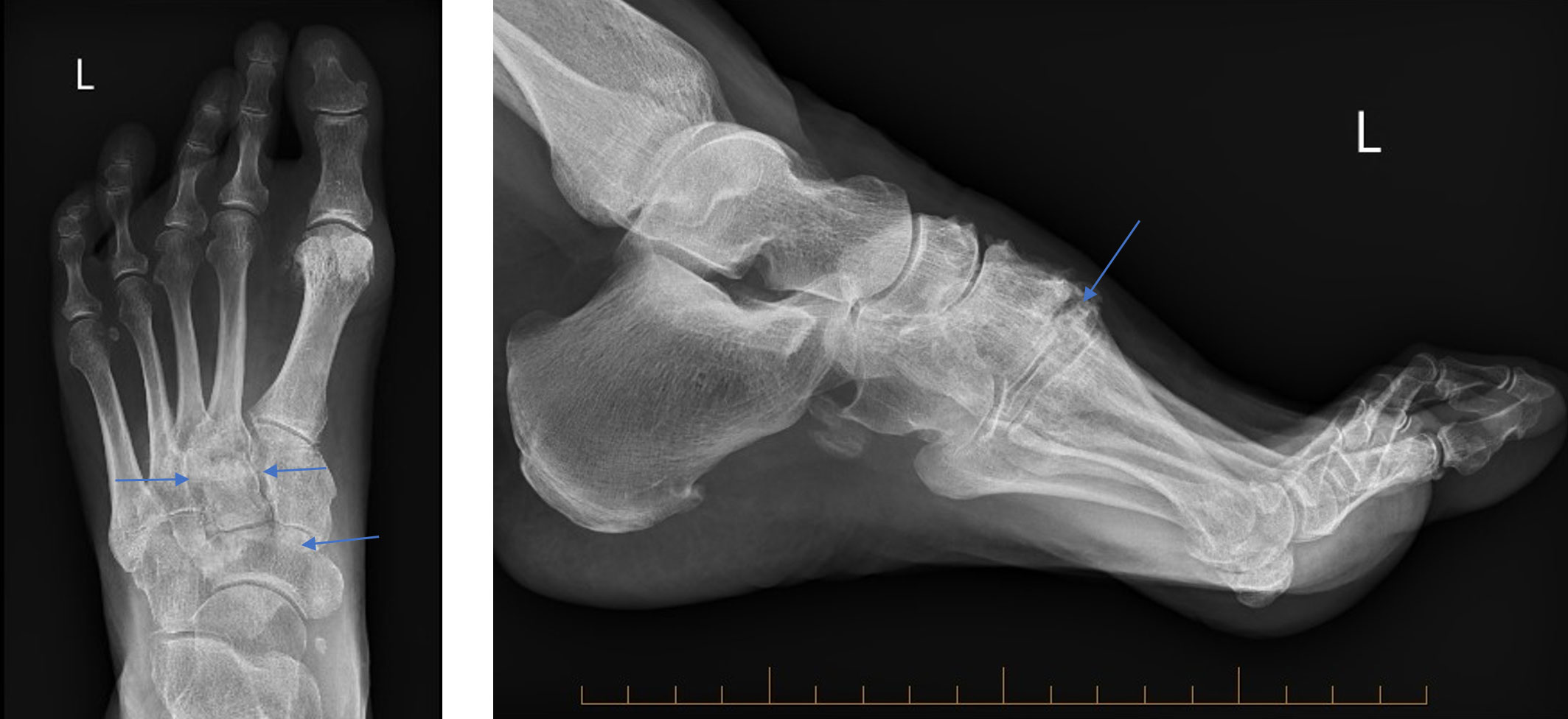 Ankle osteoarthritis may require ankle fusion surgery