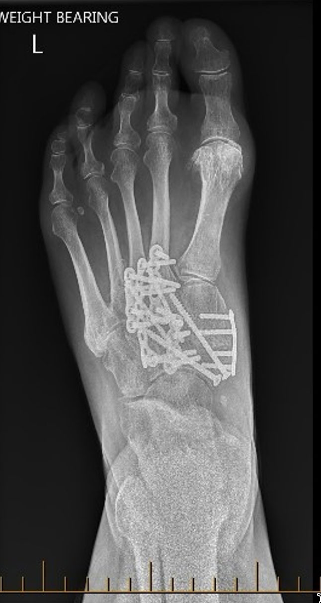 Ankle osteoarthritis may require ankle fusion surgery