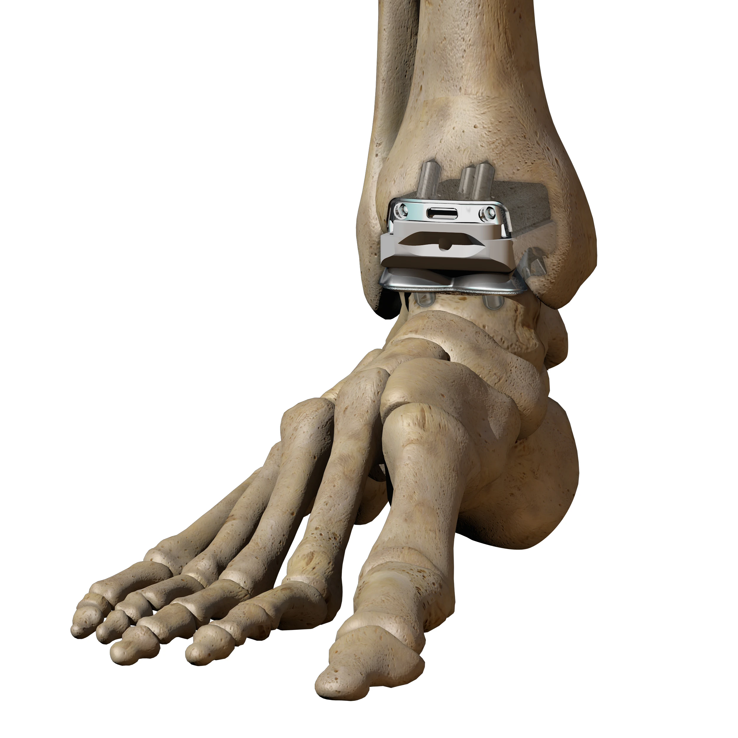 Total Ankle Replacement - Illustration of Infinity system